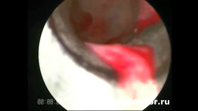 Удаление кисты верхнечелюстной пазухи (полная операция)