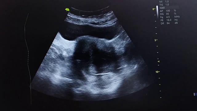 MIOMATOSIS UTERINA DE GRANDES ELEMENTOS SANGRADO TRANSVAGINAL POR MIOMAS смотреть онлайн