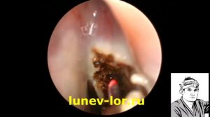 Полип носа, удаление лазером 09022018 с2