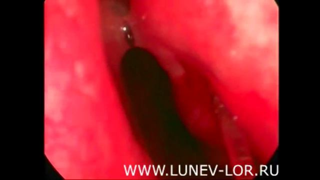 Лазерная деструкция нижних носовых раковин