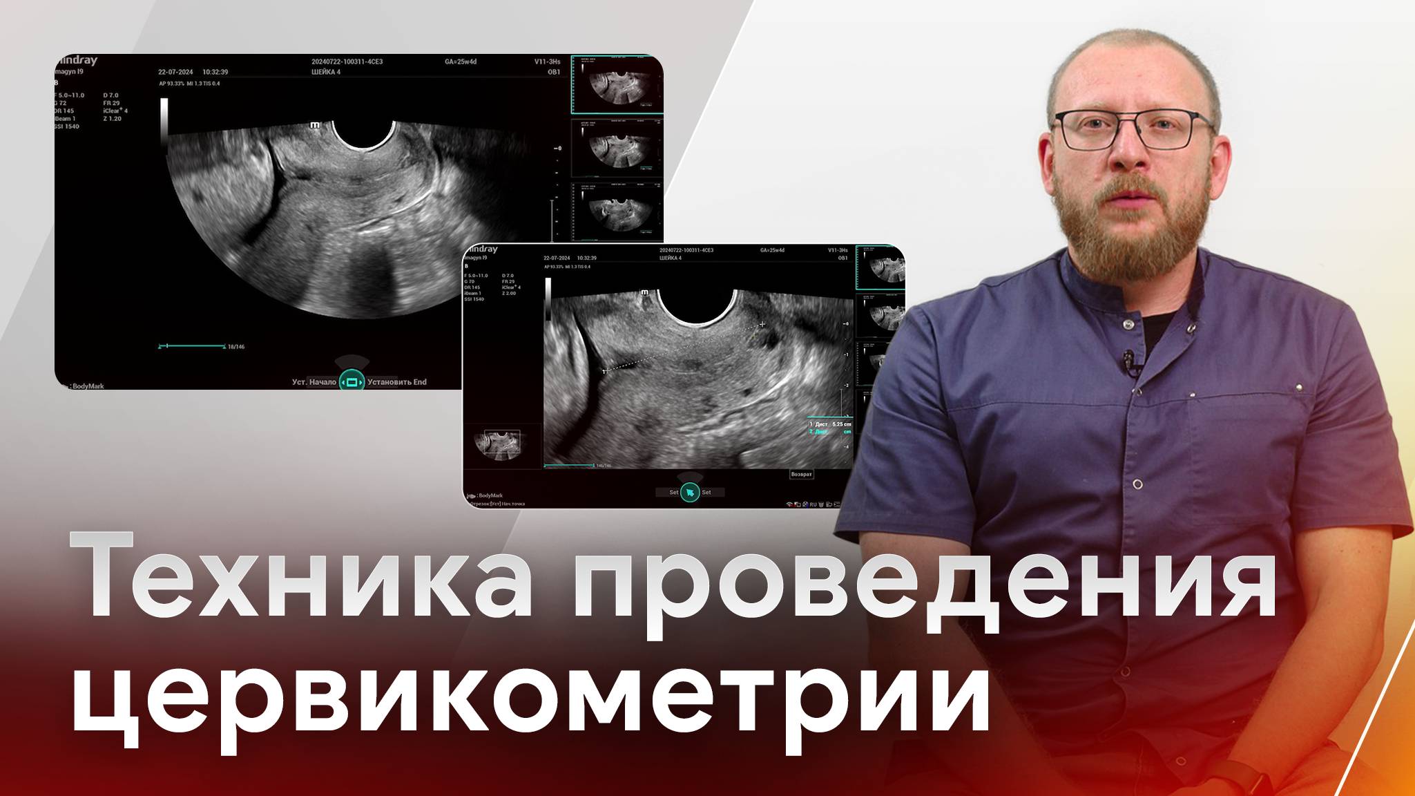 УЗИ шейки матки (цервикометрия). Показания и техника проведения смотреть онлайн