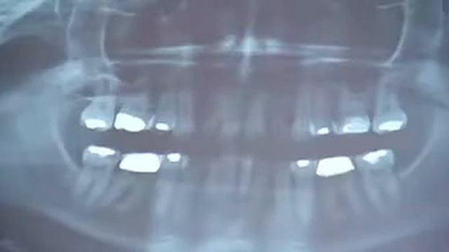 Mercury Amalgam Fillings Dangers Part 2 смотреть онлайн