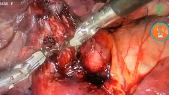 The World's first Versius Robotic Lobectomy by Dr Sven Seifert смотреть онлайн