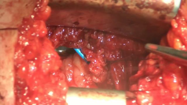 Recto Vesical Fistula M Gracillus