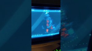 Практическое занятие 2. Выполнение ЭхоКГ при подозрении на аортальный порок сердца (Н.Ю. Неласов)