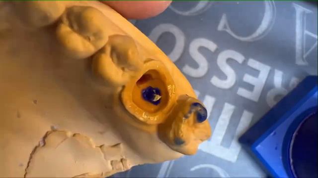 Разборная вкладка. Моляр