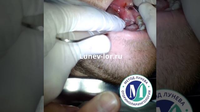 Паратонзиллярный абсцесс.