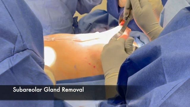 PERIAREOLAR "KEYHOLE" MASTECTOMY TOP SURGERY DR.GABRIEL DEL CORRAL смотреть онлайн