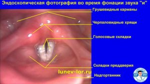 Ларингоскопия - эндоскопический осмотр гортани здорового человека.
