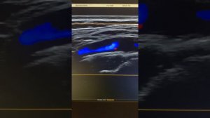 Практическое занятие. УЗИ брахиоцефальных артерий. Стеноз ВСА. О.Л. Ерошенко.