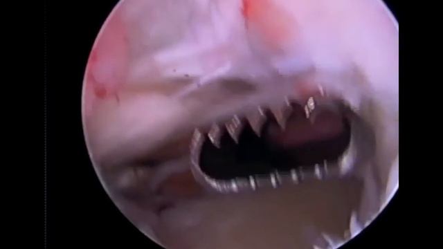 Bateman Hill Sachs HemiCAP Arthroscopic Assisted смотреть онлайн