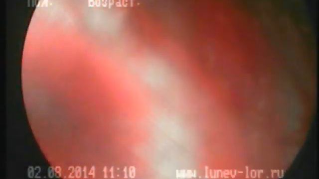 Удаление инородного тела из верхнечелюстной пазухи (полная операция)