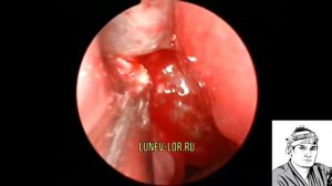 Удаление полипов носа петлей ( 27032018 С