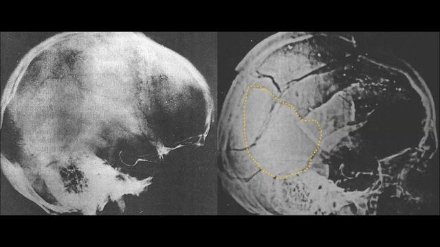 Additional findings in the JFK autopsy X-rays. смотреть онлайн