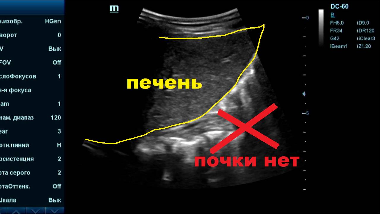 Тазовая Дистопия Почки. Тазовое Опущение Почки.