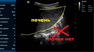 Тазовая Дистопия Почки. Тазовое Опущение Почки.