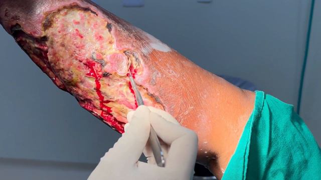 Desbridamento de Perna 4K - Leg Debridement 4K - ADR. LUCAS DUARTE смотреть онлайн