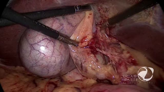 DR. LUCAS DUARTE • Laparoscopic Cholecystectomy - Colecistectomia Videolaparoscópica [25AGO21] смотреть онлайн
