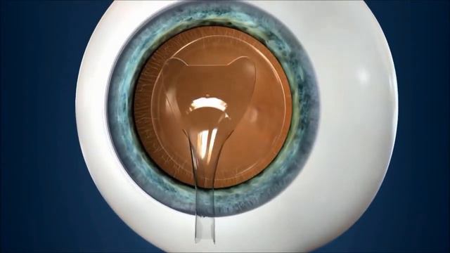 Факичные линзы