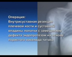 Органосохраняющие операции при опухолевых поражениях плечевой кости