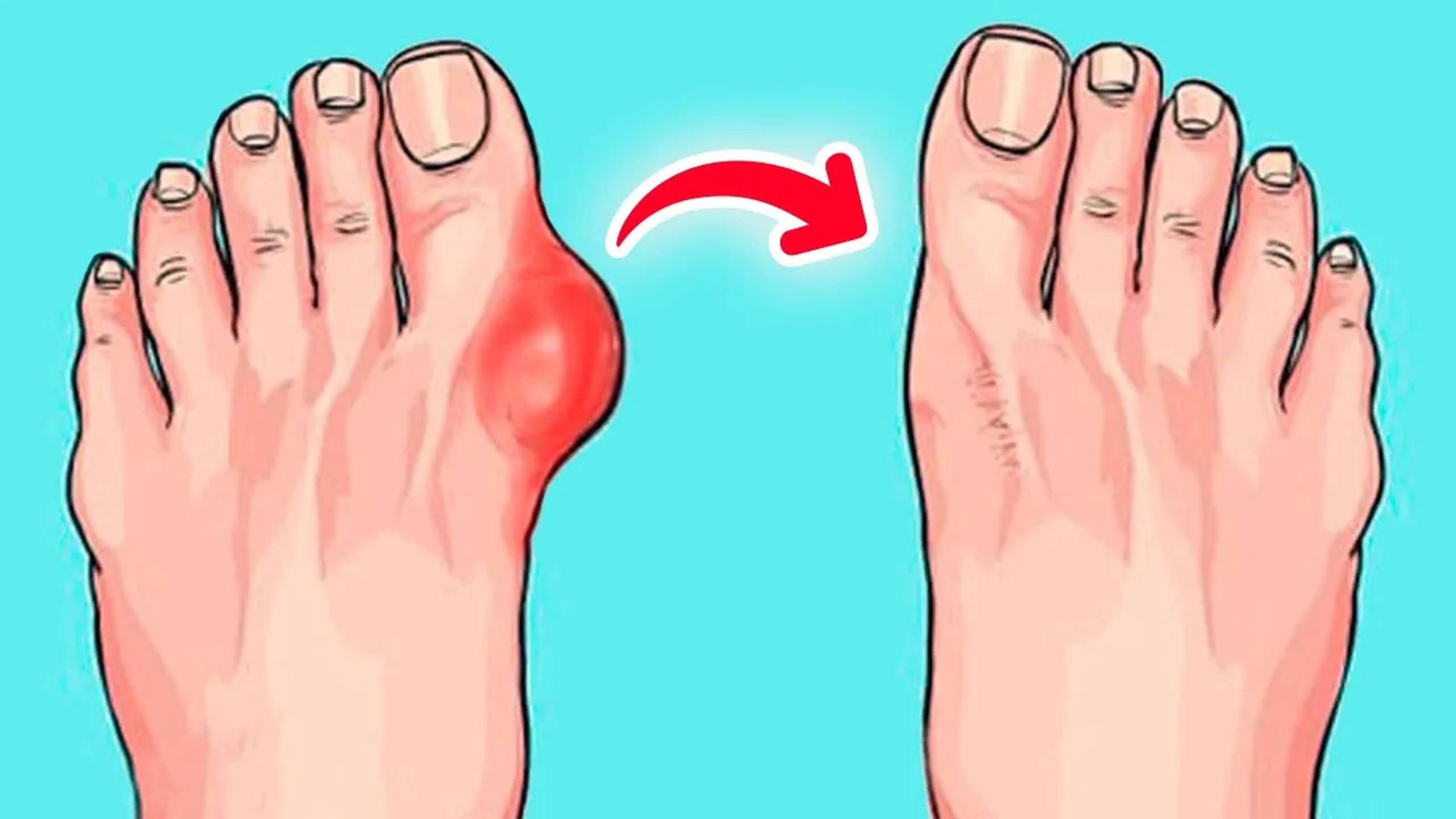 Убери косточку на стопе за 1 минуту! Эффективные упражнения от вальгусной деформации стопы смотреть онлайн