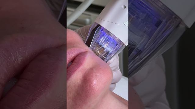 Игольчатый RF лифтинг Virtue - этапы процедуры | как проходит рф лифтинг в сети клиник GEN87 смотреть онлайн