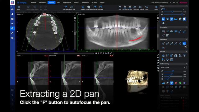 Planmeca Romexis Quick Guide for 3D Implant Planning смотреть онлайн