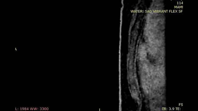 Post contrast 3D T1 Dixon volumetric breast MR imaging. смотреть онлайн