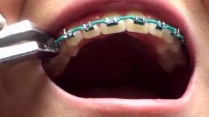 Снятие брекетов