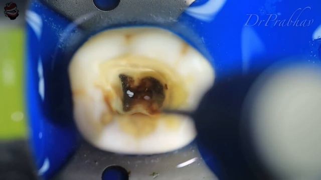 Access Opening Mandibular First Molar | Biomechanical Preparation | step by step смотреть онлайн