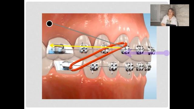 22. Биомеханика ортодонтического лечения (720p) (1)