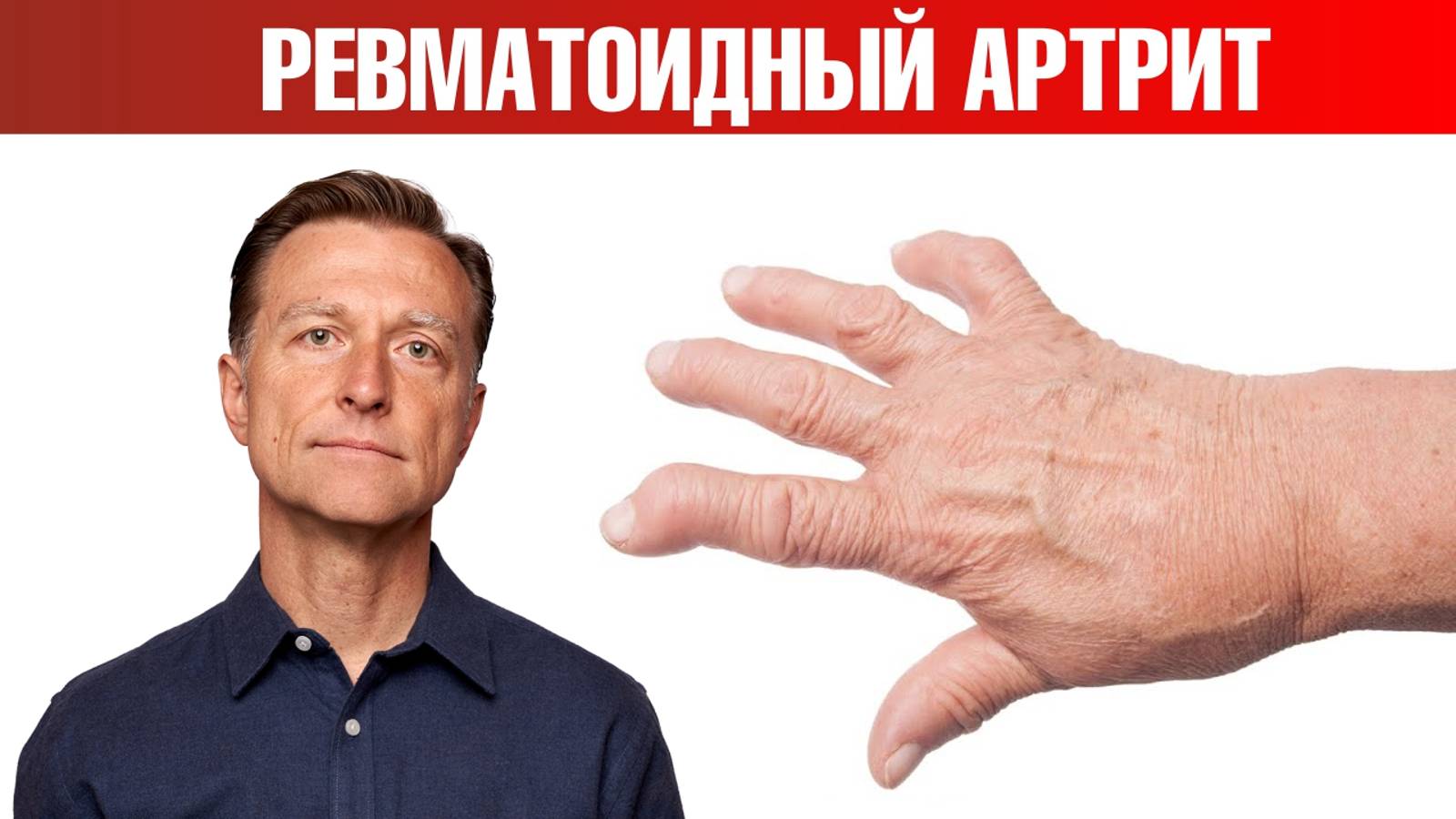 13 натуральных средств от ревматоидного артрита👌 смотреть онлайн