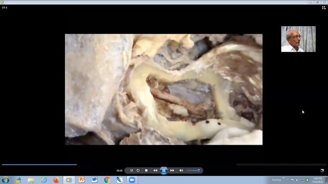 INFRATEMPORAL FOSSA (ITF) Part IV Dissecting The Mandibular Ramus...
