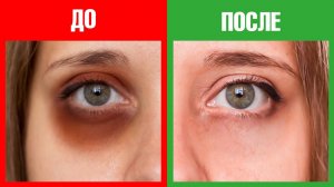 Как избавиться от темных кругов под глазами раз и навсегда?😉