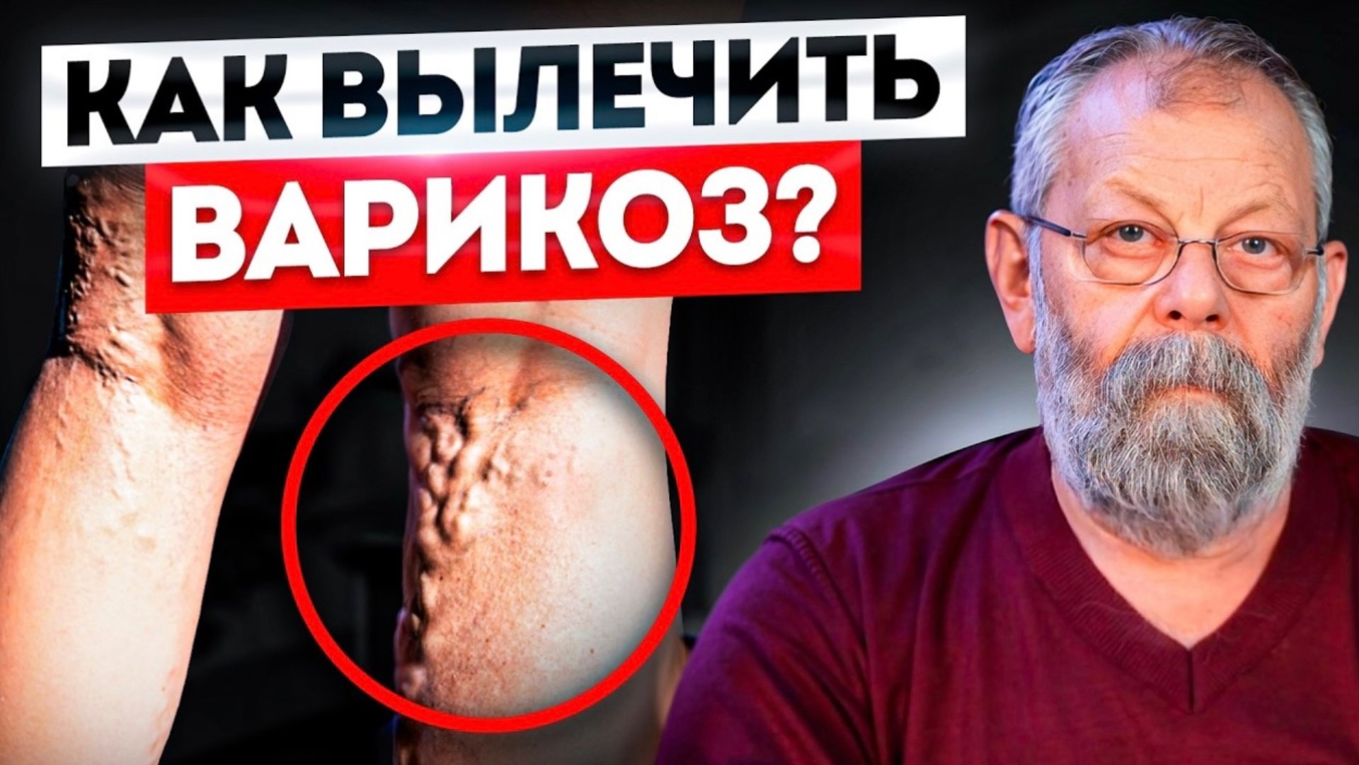 4 причины варикоза и как их устранить смотреть онлайн