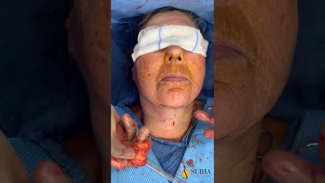 Lower Face/Neck Lift Under Local Anesthesia смотреть онлайн