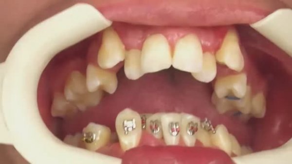 Установка брекетов