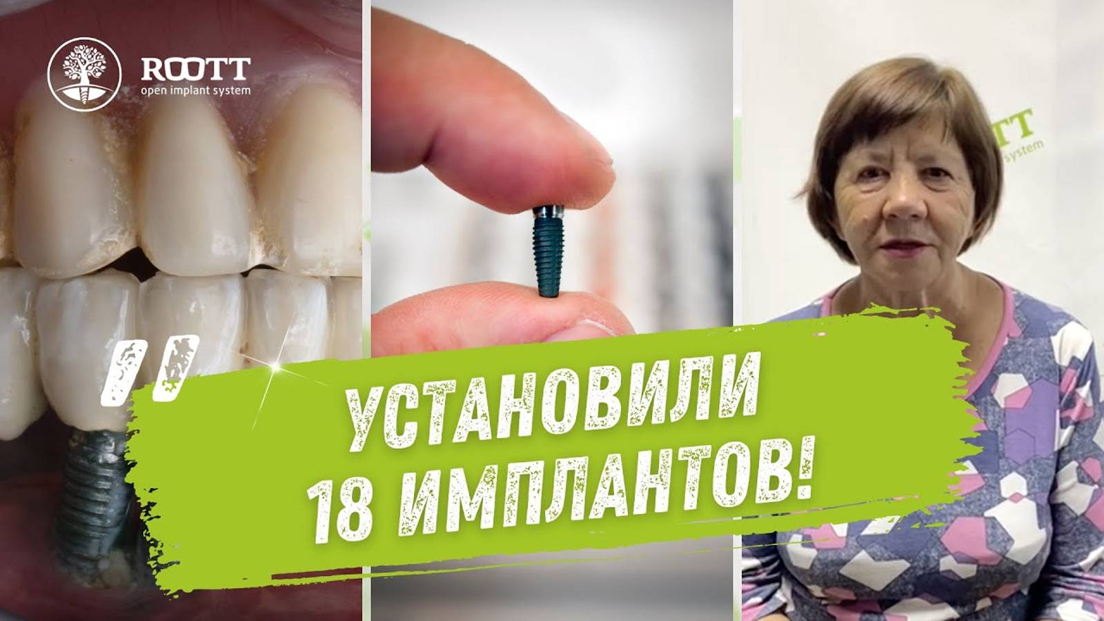 Имплантация при пародонтозе. Отзыв после 11 лет! 🦷🏥 смотреть онлайн
