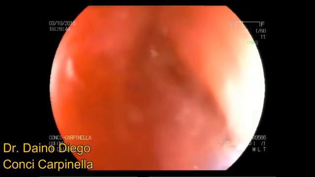 RESECCION DE POLIPO GIGANTE. POR DR. DAINO DIEGO. CORDOBA-ARGENTINA смотреть онлайн