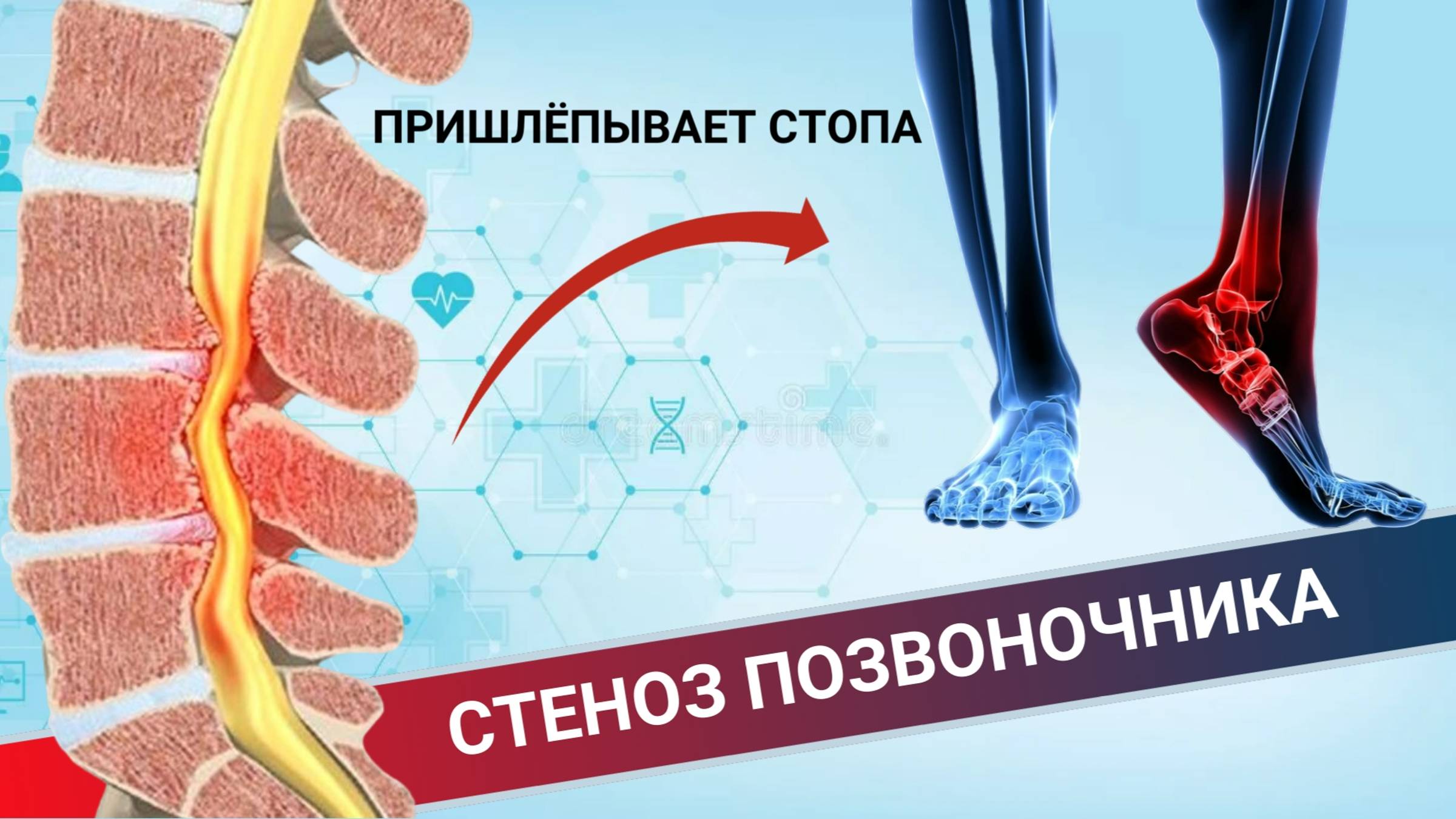 Не слушается стопа и пришлепывает смотреть онлайн