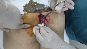 Эпителиальный копчиковый киста. ЭКК. Йиринглаган кистани очиш амалиёти.