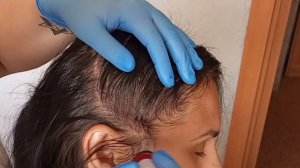 Фракционная мезотерапия кожи головы