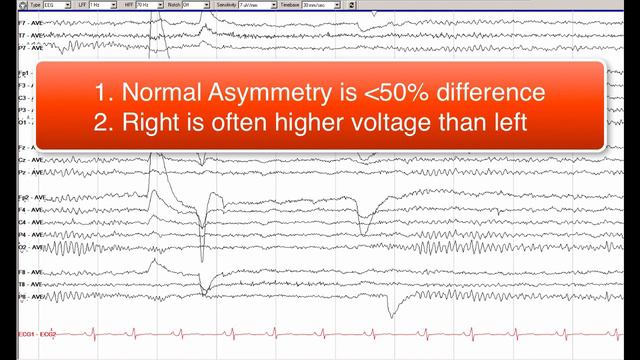 6 Normal Awake EEG смотреть онлайн