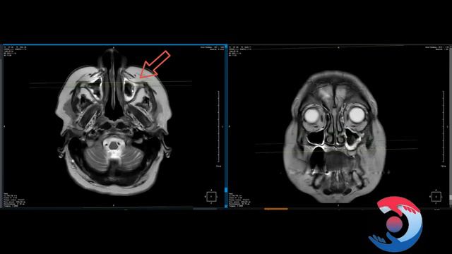 Мицетома. МРТ диагностика