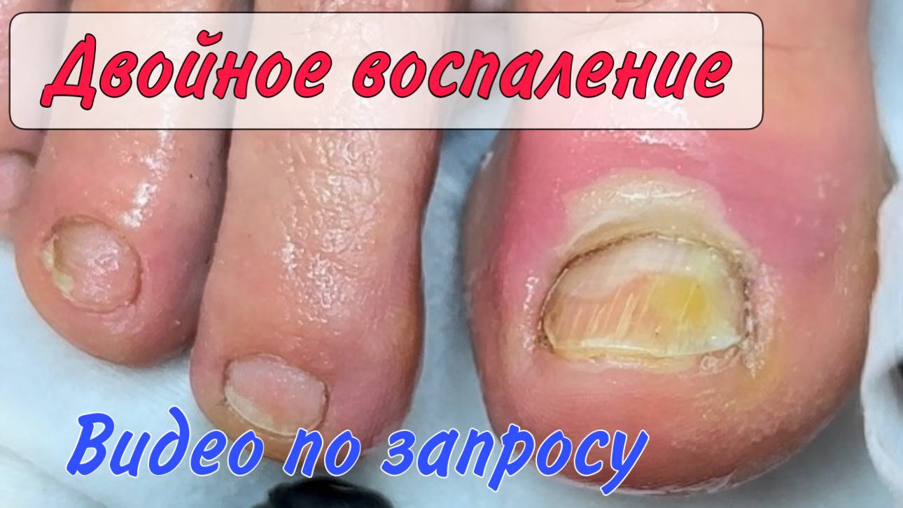 Болит палец / воспаление на пальце / паронихия / подногтевой панариций смотреть онлайн