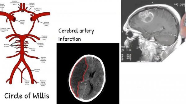 Chronic paroxysmal hemicrania vs Cluster Headache