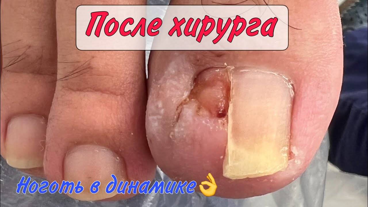 Ноготь после хирурга _ вросший ноготь _ подолог в москве смотреть онлайн