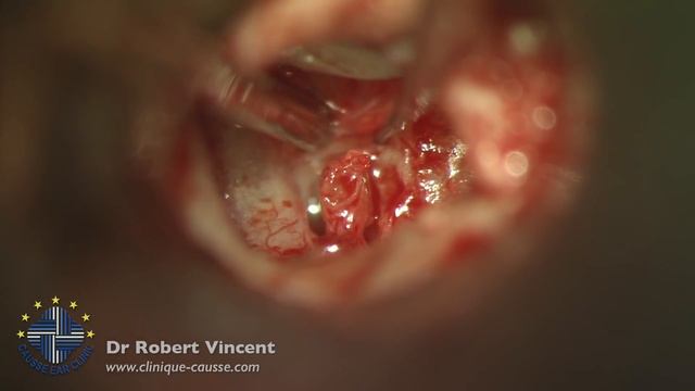 Failed Cartilage Tympanoplasty Revision with TORP and Silastic Banding смотреть онлайн