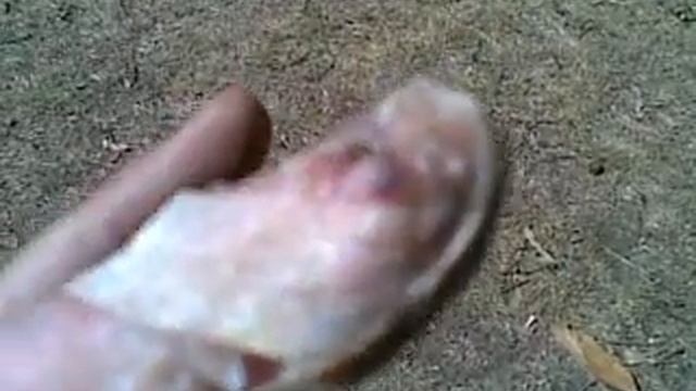 Finger Avulsion Wound, Dressing Day 19. Clip 2. Soaked & Sunbaked. смотреть онлайн