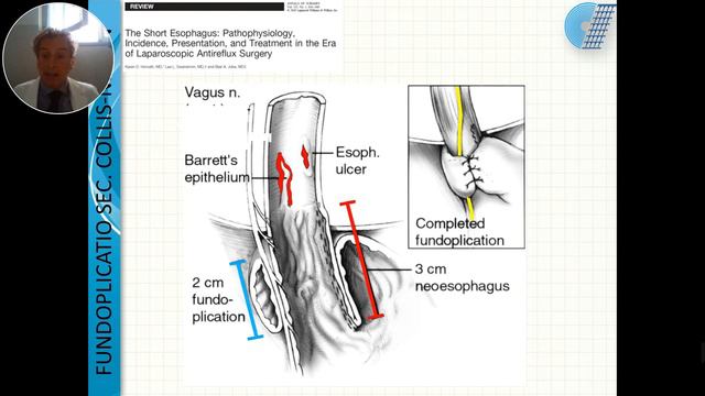 Ernie jatali giganti: gli step chirurgici. Dr. G. Pallabazzer смотреть онлайн